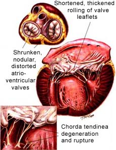 Chronic Valvular Disease