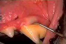 Dental Cleaning