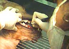 Ultrasonic Teeth Cleaning