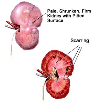Kidney - Chronic Renal (Kidney) Failure